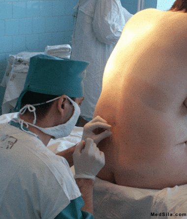 Положение во время спинальной анестезии